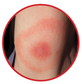 Bulls eye rash